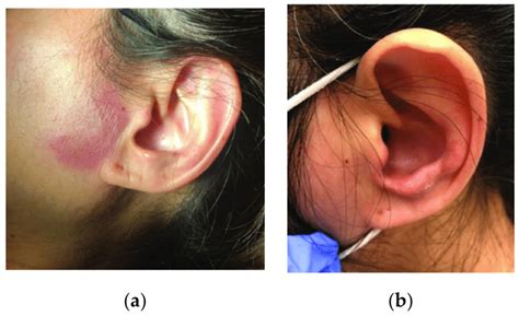 A Left Preauricular Lesion B Left Ear Edema Download Scientific