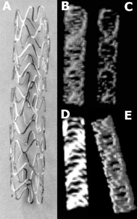 A To 4e Msct Appearance Of A 40 Mm Crossflex Lc Stent