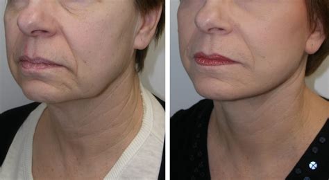 Neck Lift Plastic Surgery Pictures Benjamin Mini Brow Lift Before And