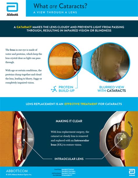 The New Cataract Surgery That Could Change Everything For The Vision