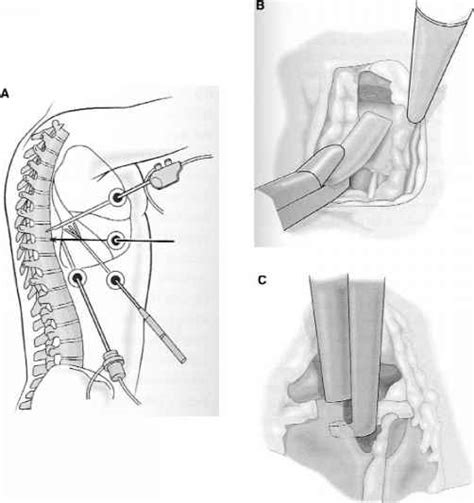 Minimally Invasive Anterior Approaches Thoracoscopy And Anterior Lumbar