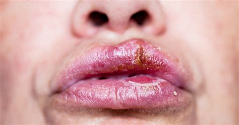 Lip Infection Bacterial Infections On Lips Learn All Causes And Treatment