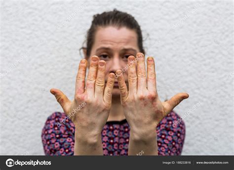 Young Woman With Dry And Stressed Red Dyshidrotic Eczema Hands By