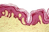 Adrenal Insufficiency