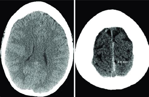 Axial Ct Scans Without Contrast Demonstrating Diffuse Cerebral Edema