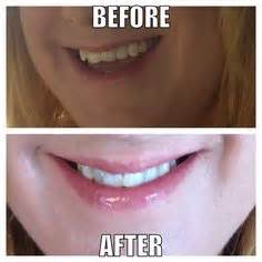With unprecedented whitening power, this teeth whitening toothpaste removes 10 years of yellow stains* while being safe for enamel. Colgate optic white on Pinterest | White Teeth, Smile and Dental Floss