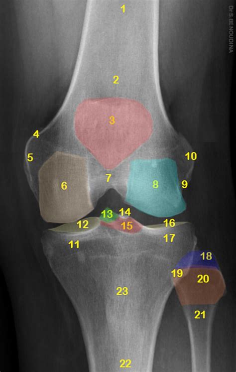 Radiopaedia Org Cases Normal Radiographic Anatomy Of The Knee 1