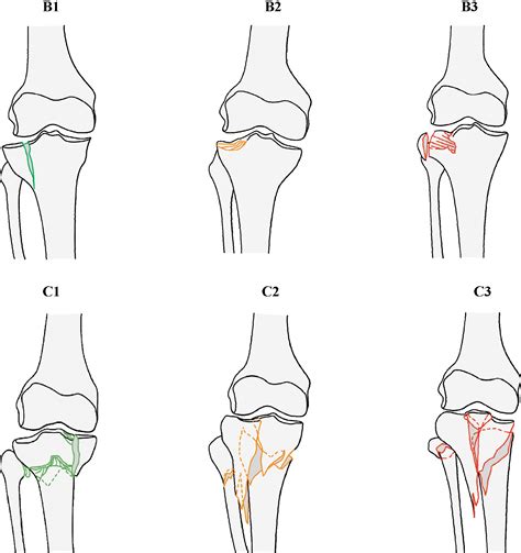 The Classification Systems For Tibial Plateau Fractures How Reliable