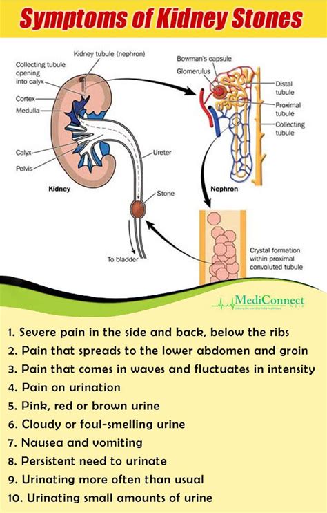 Congestive kidney in heart failure osmotic concentration of urine is. Signs and Symptoms of Kidney Stones | Kidney health ...