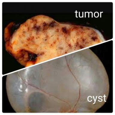 Difference Between Cyst And Tumor LORECENTRAL