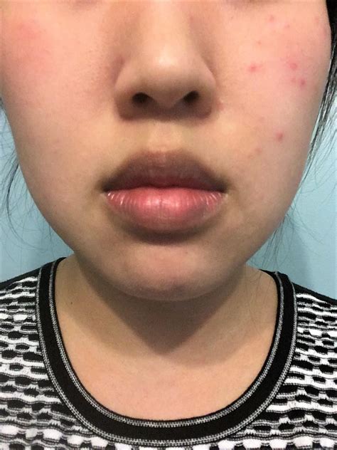 Skin Concerns Rash On Only One Side Of My Face Please Help My Poor
