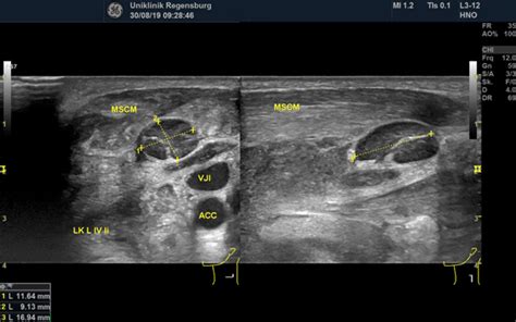 Ultrasound Findings In Actinomyces Infection Of The Neck Augsep 2020