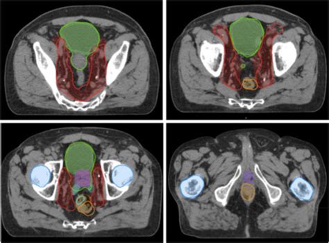 Atlas Predicted Contouring For High Risk Prostate Cance Open I