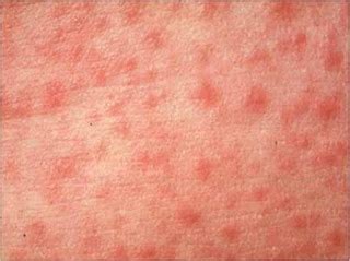 The infection is always in the same area around an. Philadelphia Ujima: Have a Problem with Cosmetics You ...