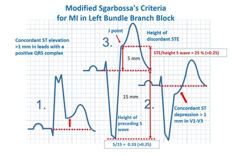 Modified Sgarbossa S Criteria For MI In Left Bundle Branch Block ClinCaseQuest