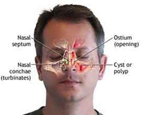 Theonedestiny Nasal Polyps
