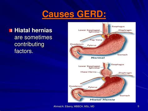 Recent Management Of Gerd From Consensus To Clinical Application Dr T B80