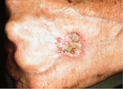 Early Squamous Cell Skin Cancer On Face