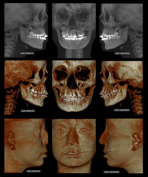 El Uso De La Tomograf A Cone Beam D En La Ortodoncia Cdi