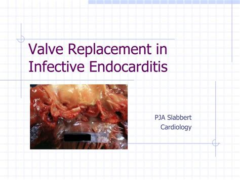 PPT Valve Replacement In Infective Endocarditis PowerPoint Presentation ID