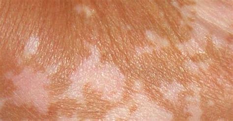 Comment Se Débarrasser Des Taches Blanches Sur La Peau Le Vitiligo
