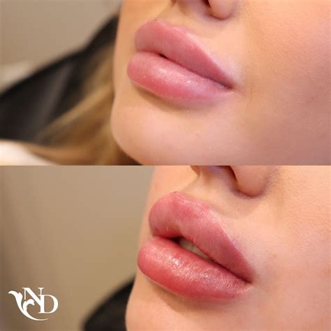 Lip Filler Beforeafter Facial Fillers Lip Fillers Botox Lips