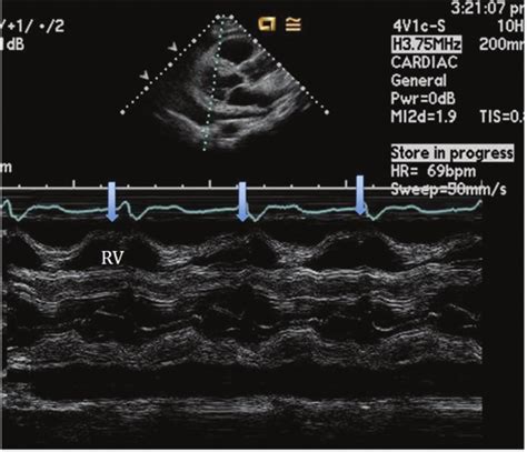 M Mode Of The Parasternal Long Axis View Establishing The Diagnosis Of