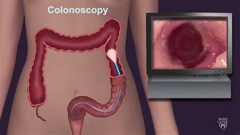 Keeping Patients More Comfortable During A Colonoscopy Youtube
