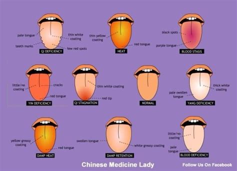 Image Result For Ayurvedic Tongue Diagnosis Chart Helse