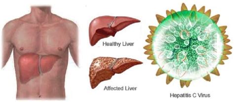 It's caused by the hepatitis c virus. 10 Essential Facts About Hepatitis C : Human N Health