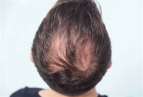 Las Mejores 147 Remolino En El Cabello Hombre Mx