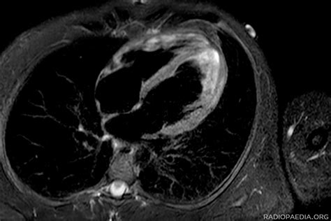 At present, no diagnostic gold standard is. The Real Reason Post-COVID Myocarditis Is a Worry ...