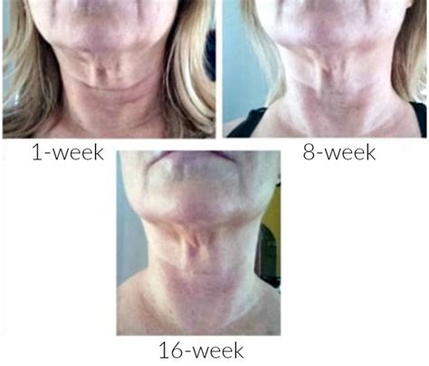 Sagging Neck Skin How To Reduce And Prevent Wrinkles And Sagging