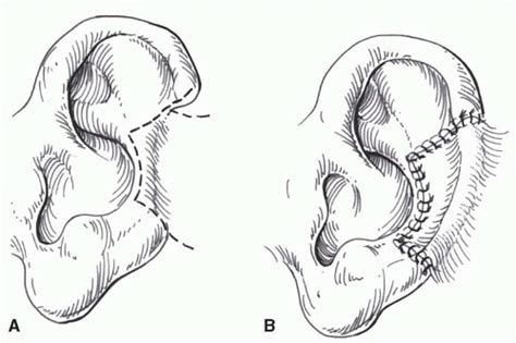 Ear Reconstruction Plastic Surgery Key