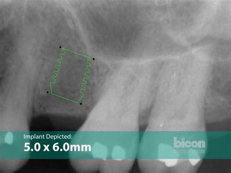 The Bicon Short Implant Surgical Technique Bicon Dental Implants