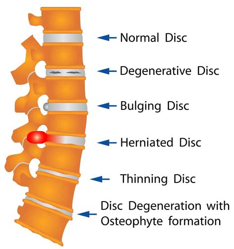 What are the Causes and Symptoms of a Disc Herniation? - Advanced