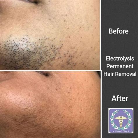 Details More Than 63 Electrolysis For Facial Hair Latest Ineteachers