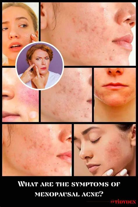 What Is Menopausal Acne And How To Manage It