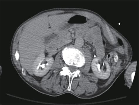 Figure 3 From Laparoscopic Repair Of An Abdominal Intercostal Hernia