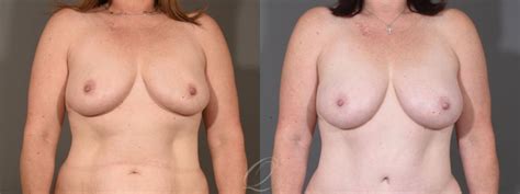 Breast Augmentation With Fat Transfer Before After Photo Gallery
