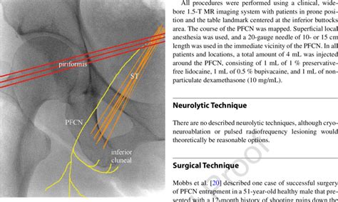 Lateral Femoral Cutaneous Nerve Anatomy