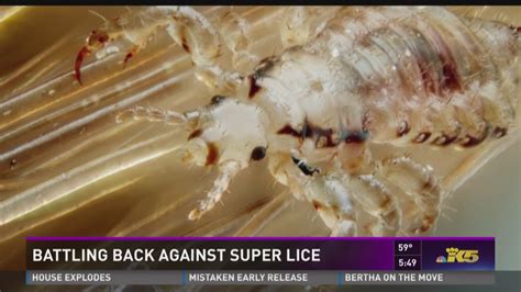 'Super lice' hits 25 states, including California | abc10.com