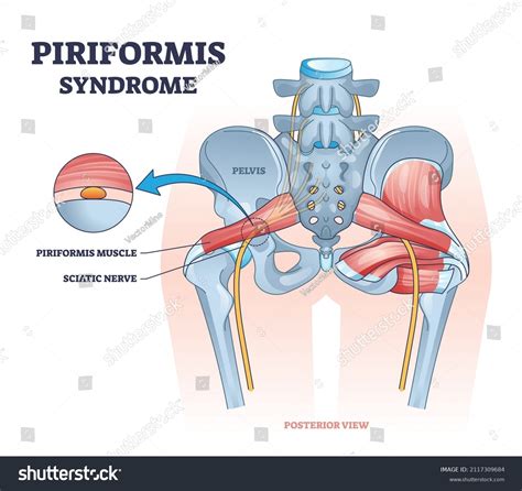 Piriformis Syndrome Sciatic Nerve Compression Pain Stock Vector Royalty Free