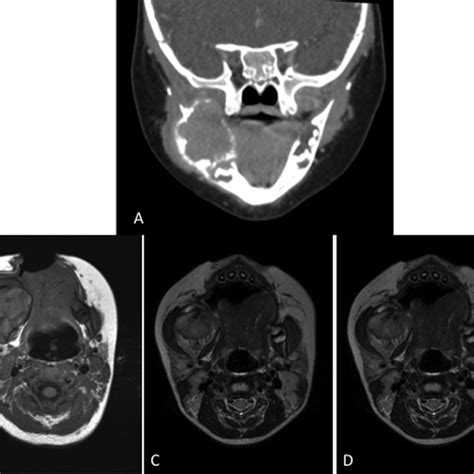 Radiological Presentation A Coronal Ct Scan Obtained With Soft Tissue