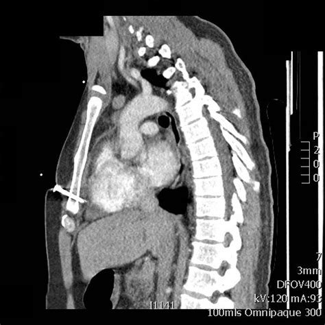 Penetrating Chest Trauma CThSurgery