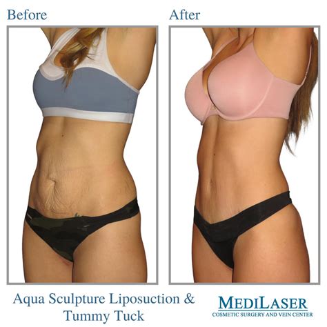 Tummy Tuck And Liposuction Before And After Medilaser Surgery And