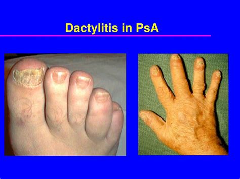 Ppt Psoriatic Arthritis Clinical Features And Epidemiology Powerpoint