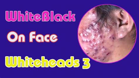 How To Remove Popping Blackheads And Whiteheads Cysts Blackheads
