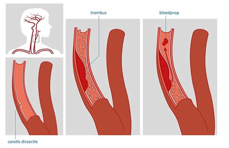 Herseninfarct Hersenbloeding Behandeling