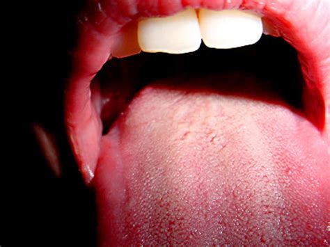 16 Million Americans Have Hpv In Their Mouths Mostly Men Cbs News